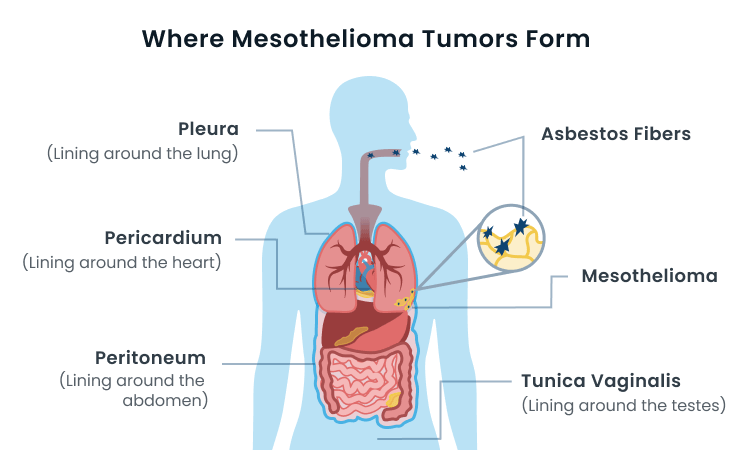 Stage 3 Mesothelioma Life Expectancy